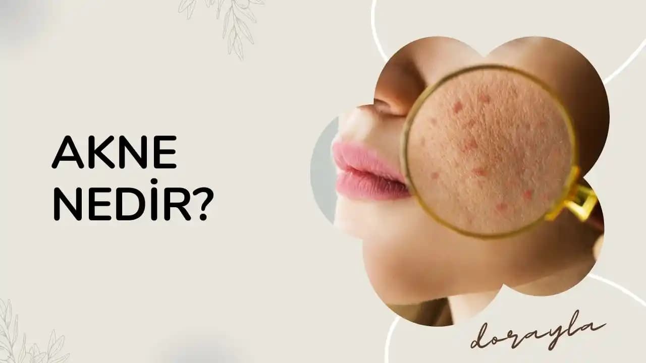 Akne ve Bağırsak-Cilt Ekseni: Diyet, Hormonal Faktörler ve Bireysel Etkiler Üzerine İnceleme