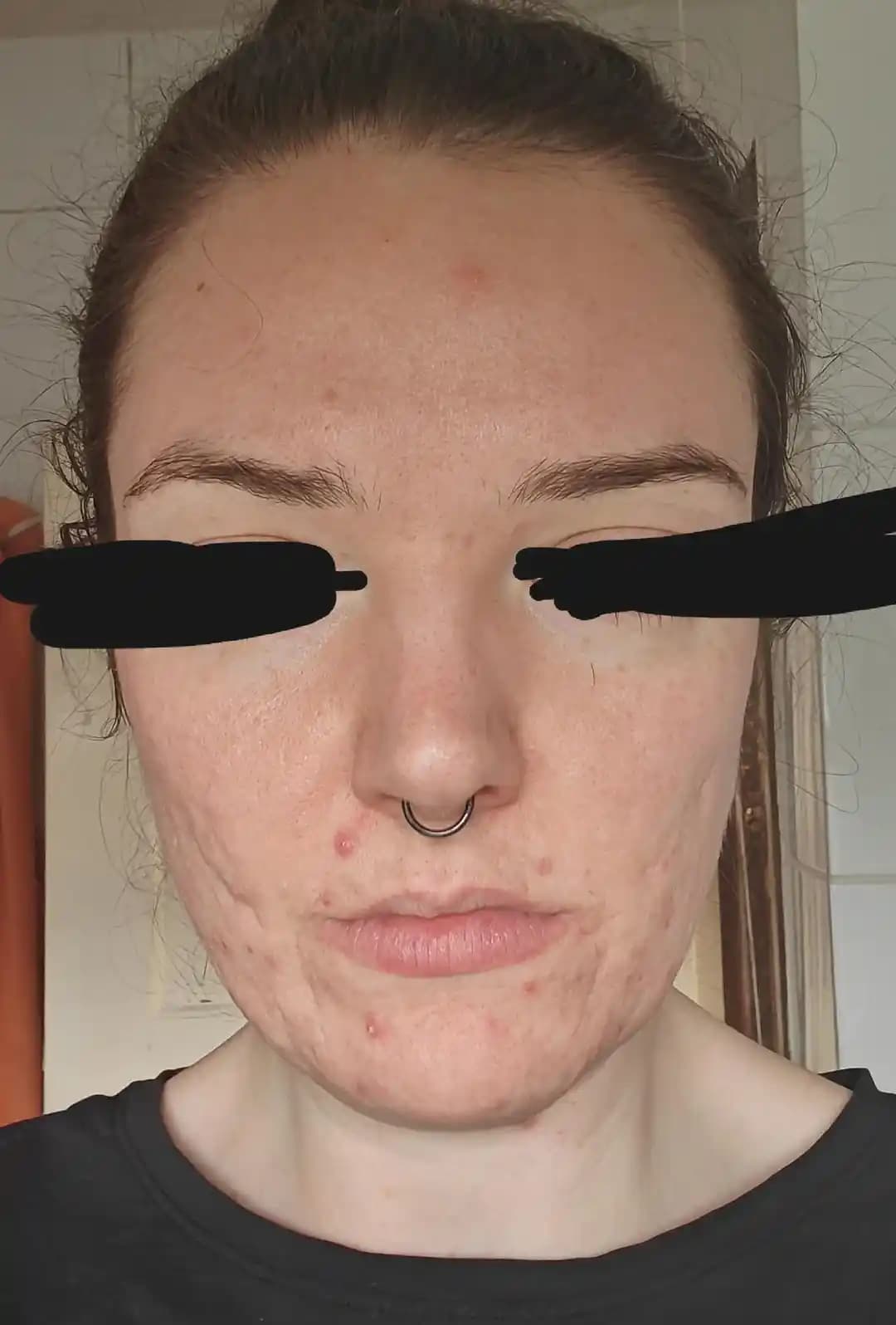 Akne ve Kızarıklık İçin Etkili Cilt Bakım Rutini ve Tedavi Yöntemleri