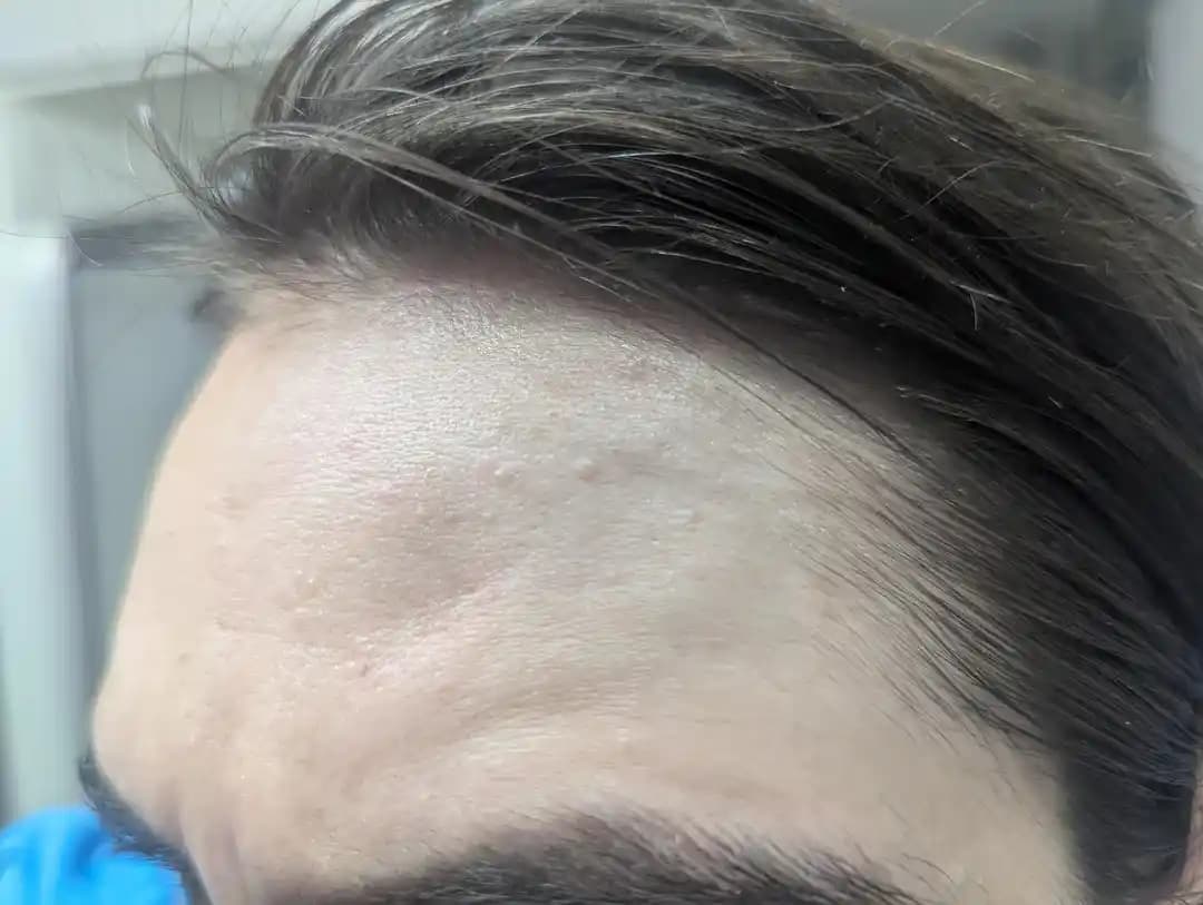 Alında Sebaceous Hyperplasia: Belirtiler, Tanı ve Etkili Tedavi Yöntemleri