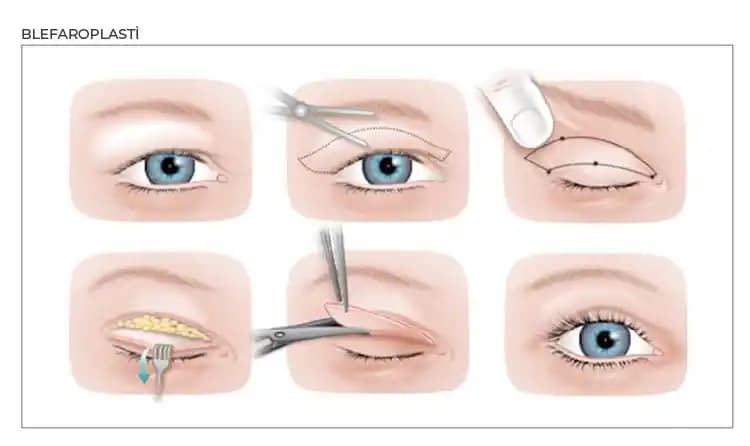 Alt Göz Kapağı Blefaroplasti ve CO2 Lazer Tedavisi ile Göz Altı Estetiğinde Kalıcı Çözümler