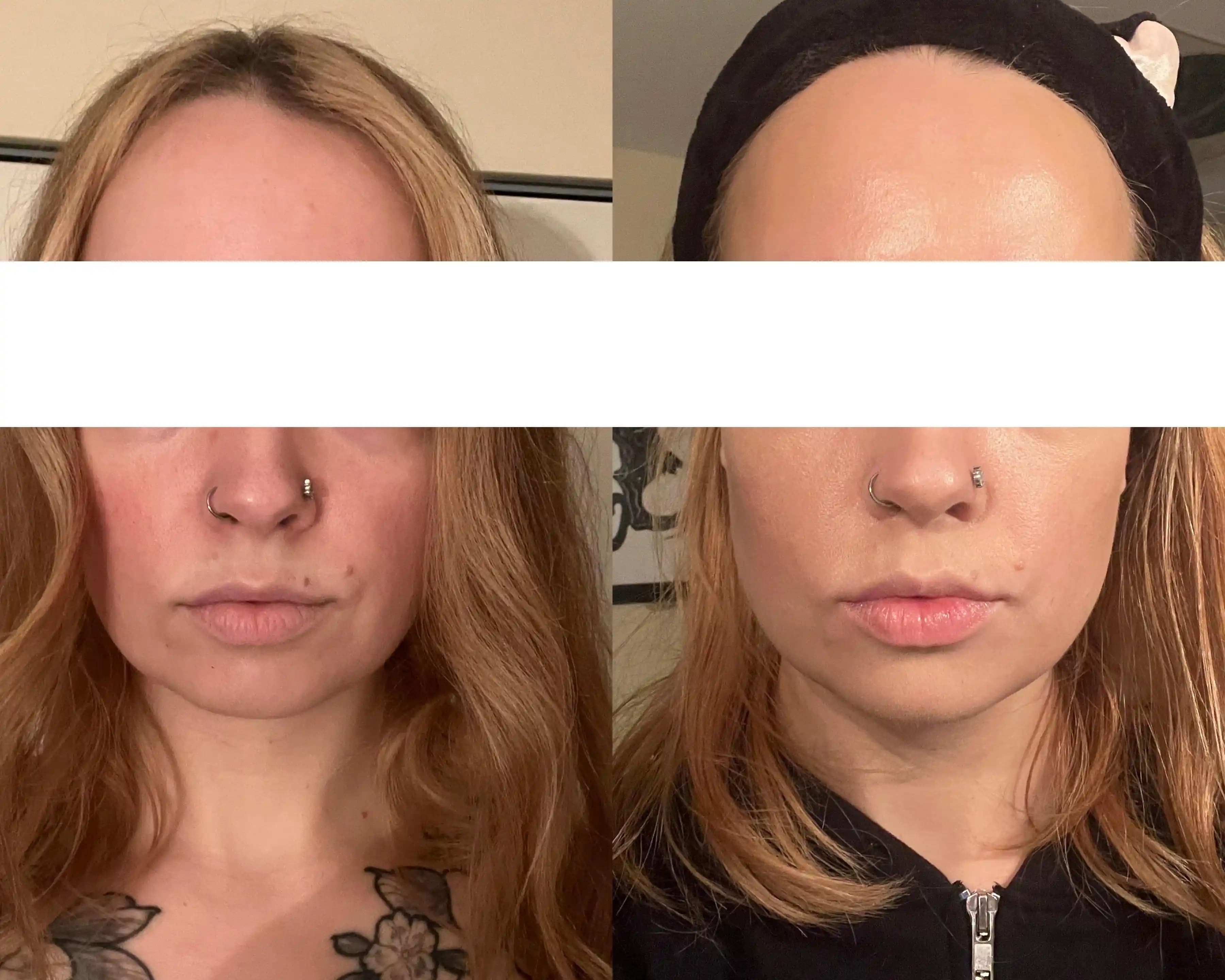 Alt Yüz Estetiğinde Masseter Botox, Mikroiğne RF ve Lenfatik Masajın Karşılaştırmalı Analizi