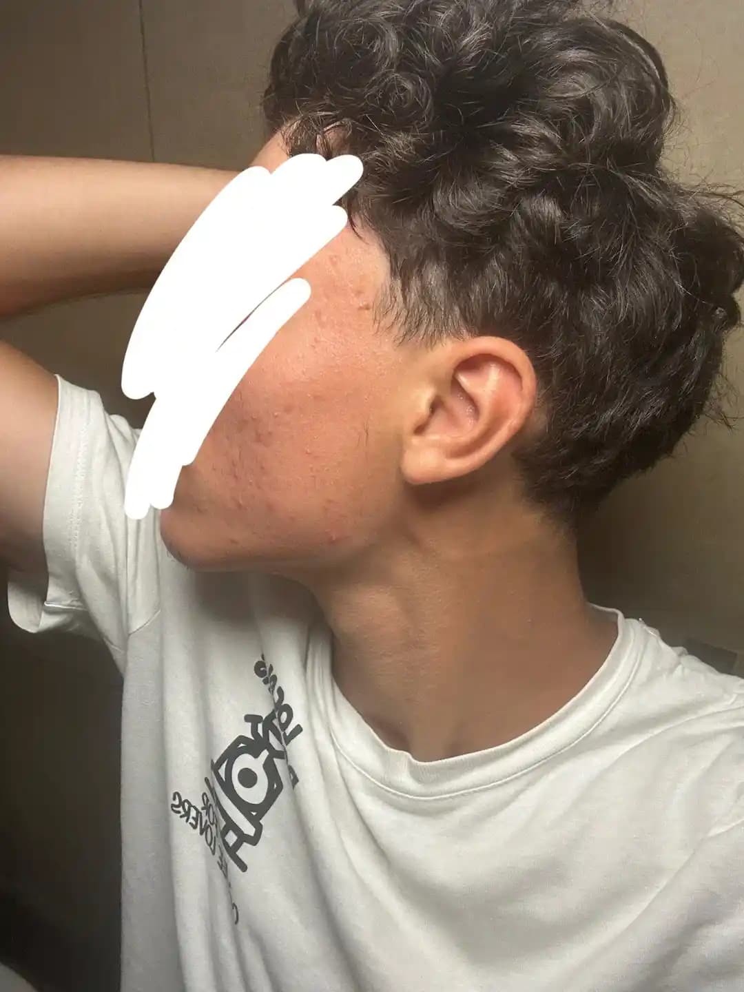 Ani Akne Patlamalarının Nedenleri, Tedavi Yöntemleri ve Dermatolojik Yaklaşımlar