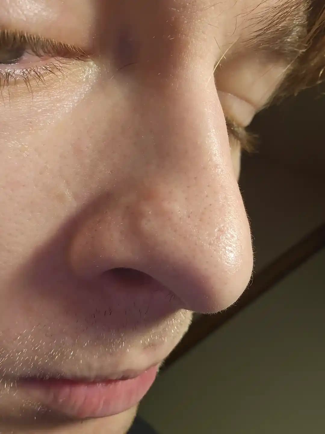 Başsız ve Ağrılı Burun Aknesi: Tedavi Yöntemleri ve İz Bırakma Riskleri Üzerine Analiz