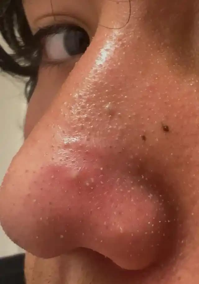 Burundaki Genişlemiş ve Dolmuş Gözeneklerin Etkili Tedavi Yöntemleri ve Bakım Rehberi