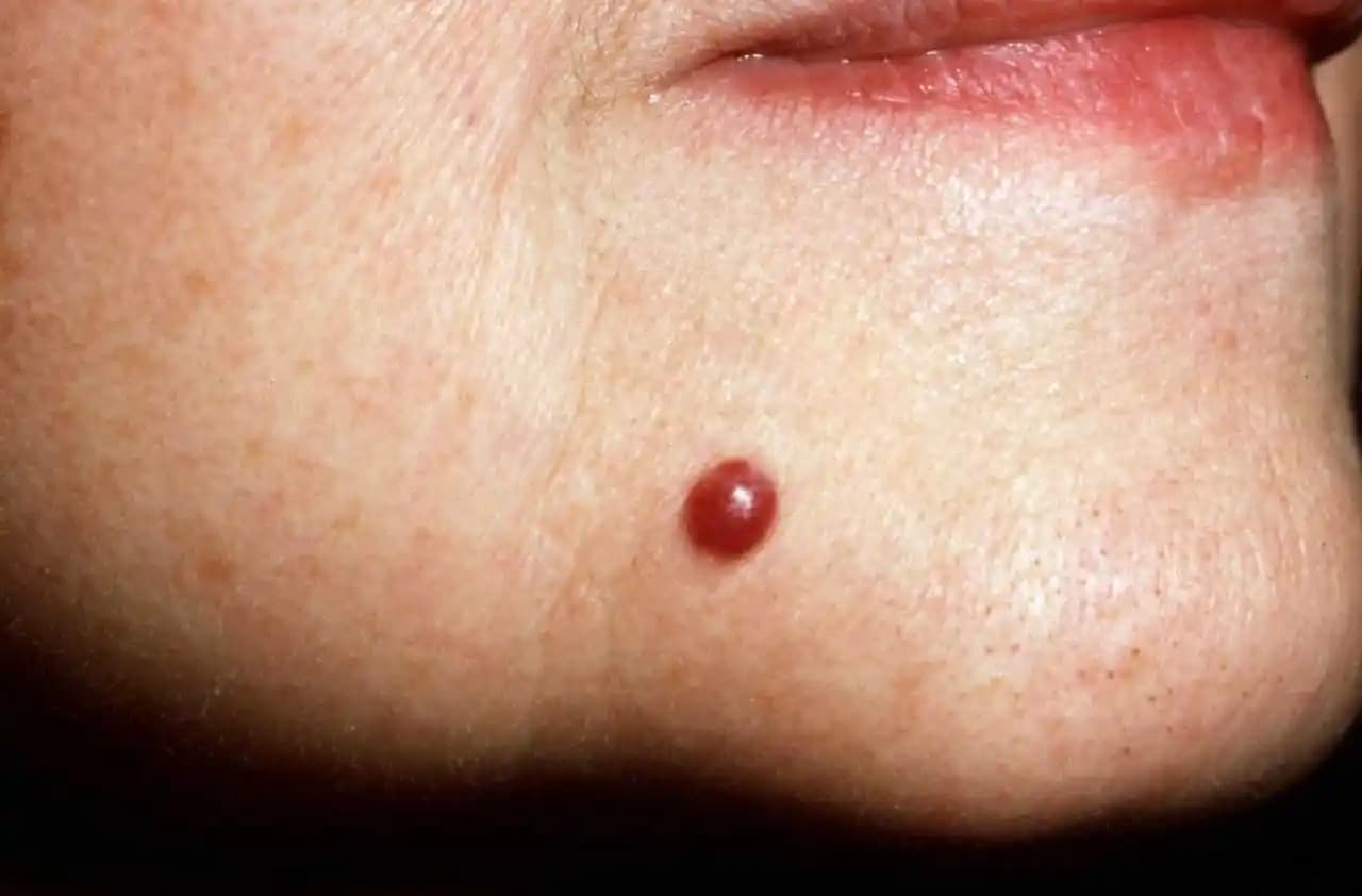 Cherry Anjiyomlar: Yaşlanma, Genetik ve Hormonal Etkilerle Ciltte Görülen Kırmızı Lezyonlar