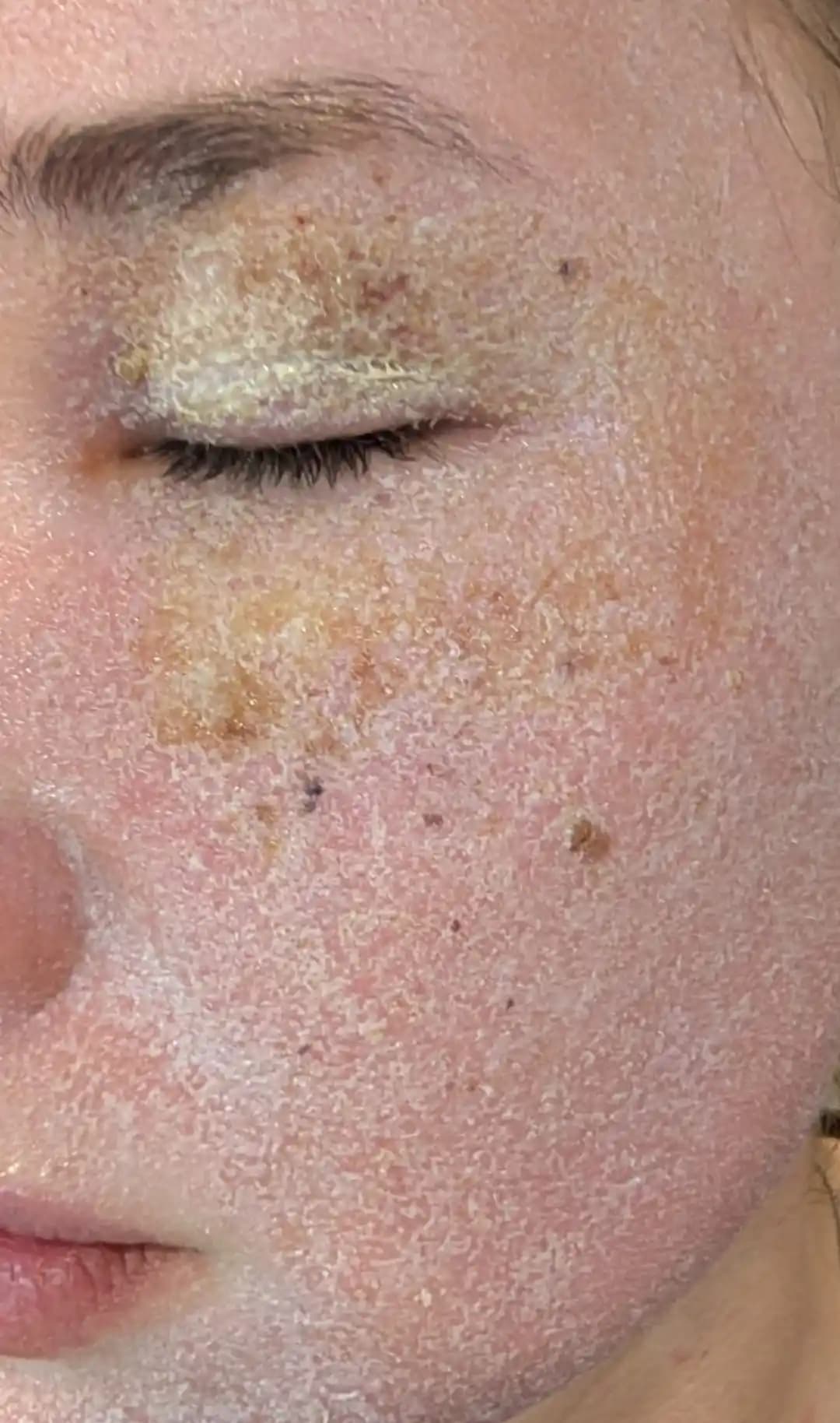 CO2 Lazer Tedavisi Sonrası Ciltteki Değişiklikler ve Etkili Bakım Yöntemleri