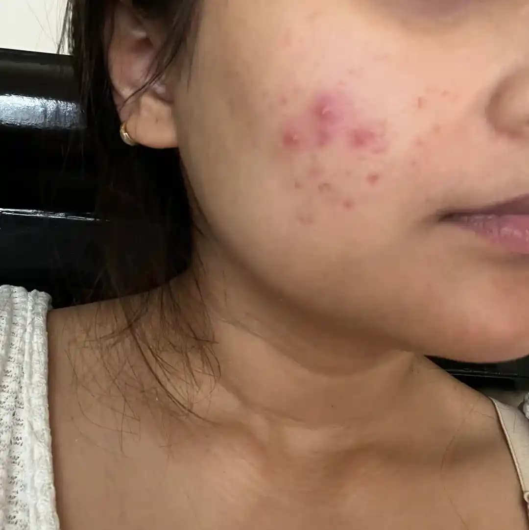 Düğüne 3 Ay Kala Akne Problemleri ve Etkili Tedavi Yöntemleri