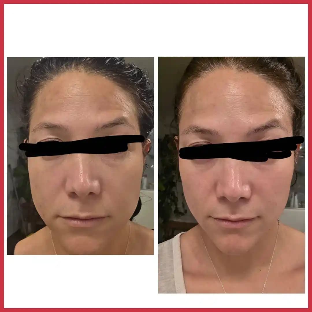 Estriol Krem ve Sunday Riley A+ Retinoid Serumun 4 Haftalık Cilt Bakımındaki Etkileri