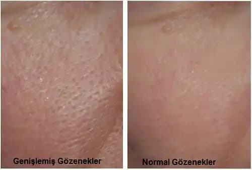 Genişlemiş Gözenekler İçin Asya Güzellik Ürünleri ve Etkili Bileşenlerin İncelenmesi