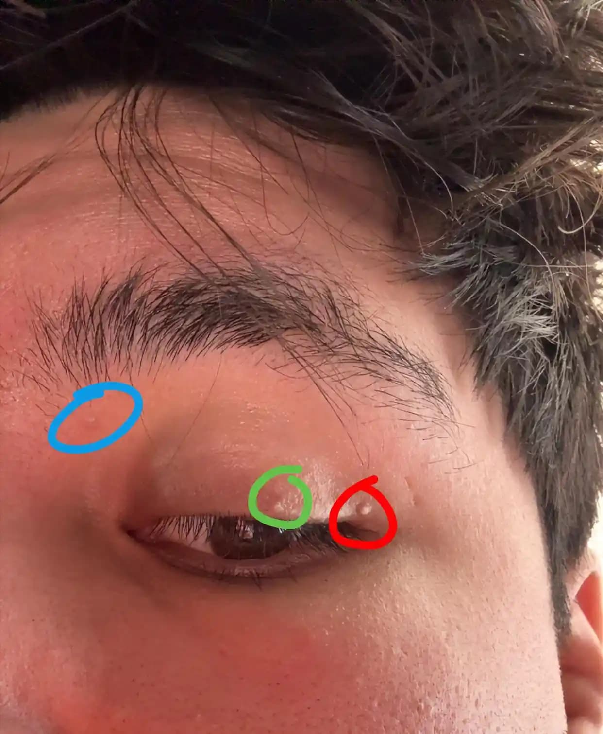 Göz Çevresindeki Milia Nedir, Neden Oluşur ve Nasıl Güvenle Tedavi Edilir