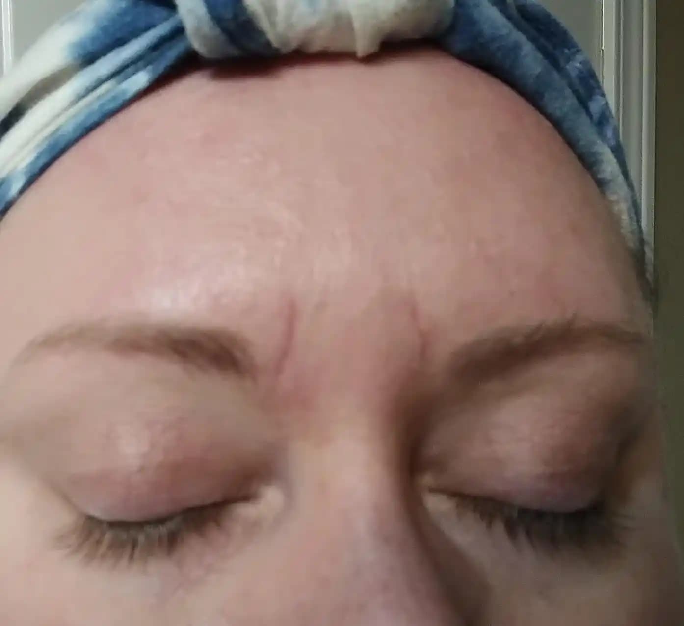 Gözlük İzleri ve Yara İzlerinin İyileştirilmesinde Bilimsel Yaklaşımlar ve Uygulamalar