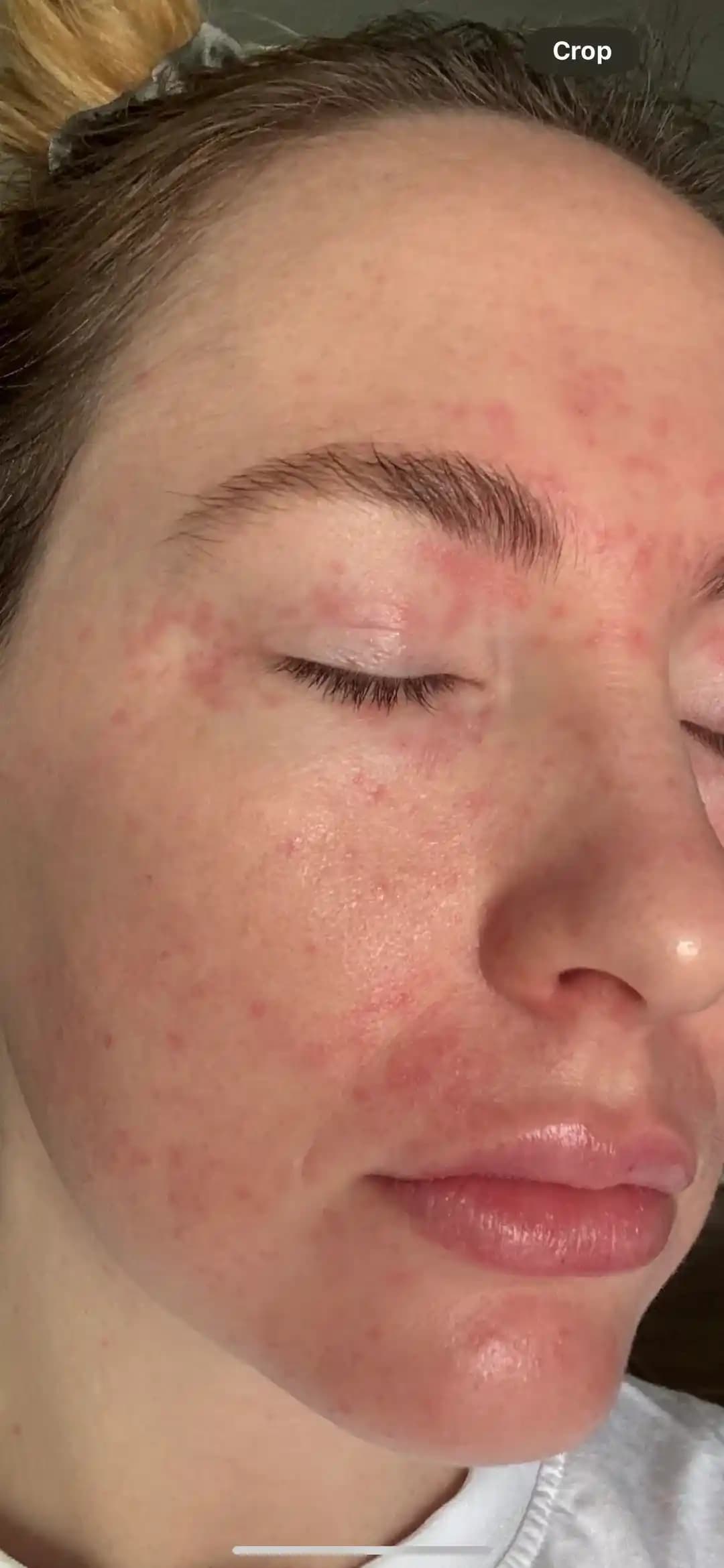 Hamilelik Sonrası Cilt Sorunları ve Dermatit: Belirtiler, Nedenler ve Tedavi Yöntemleri