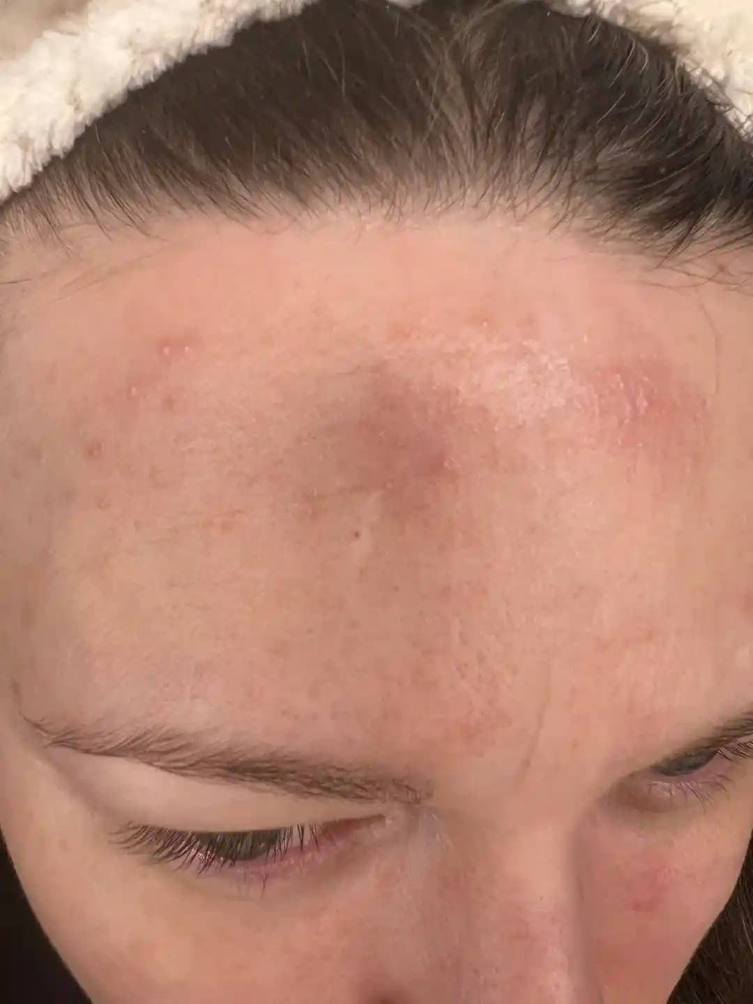 Hassas Ciltlerde Cilt Bariyerinin Bozulması ve Etkili Bakım Yöntemleri