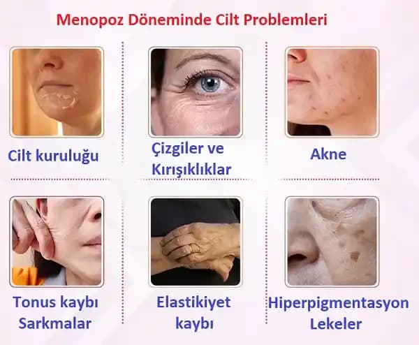 Hormon Dengesizliği ve Tretinoin Kullanımının Cilt Sağlığı Üzerindeki Etkileri