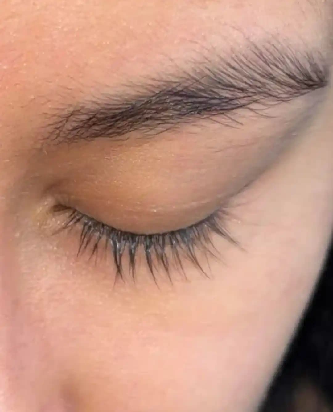 Kirpik Serumlarının Periorbital Yağ Kaybı ve Yan Etkileri Üzerine Detaylı İnceleme