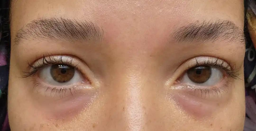 PDGF Göz Altı Enjeksiyonları: Uygulama, Sonuçlar ve Risklerin Değerlendirilmesi