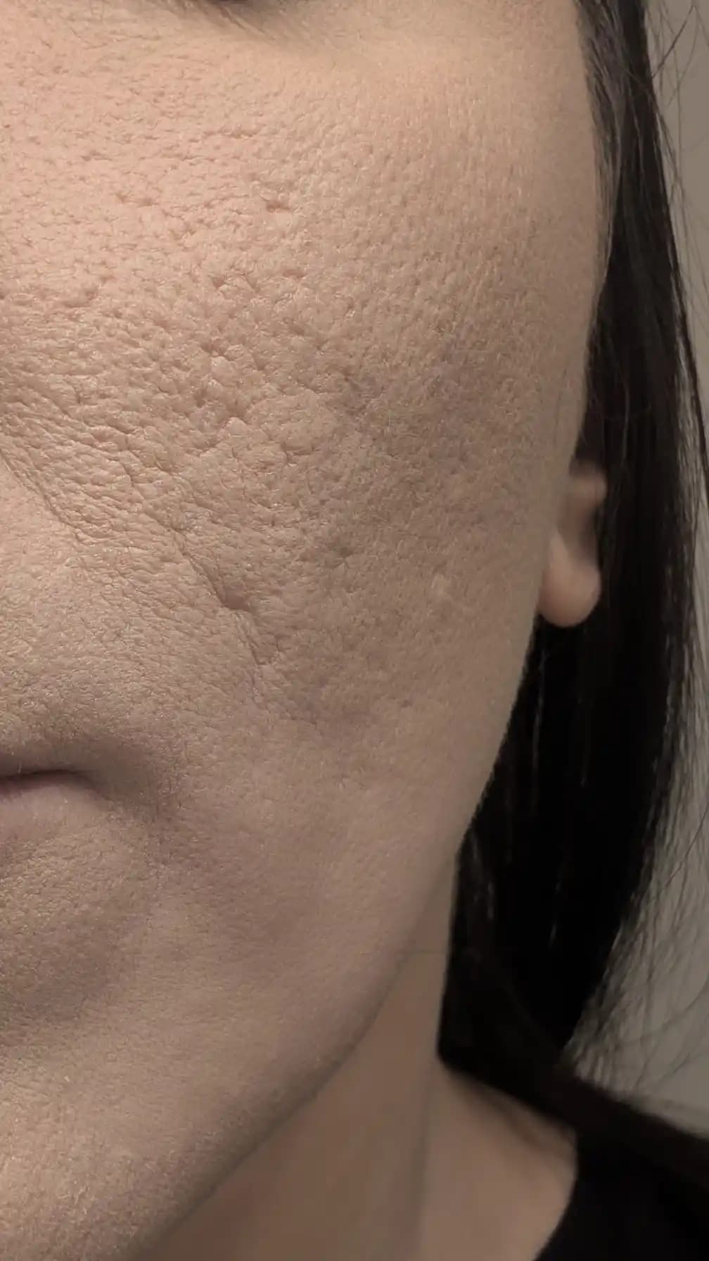 Sistik Akne İzleri ve Çukurlarının Tedavisinde Uygun Fiyatlı ve Etkili Yöntemler