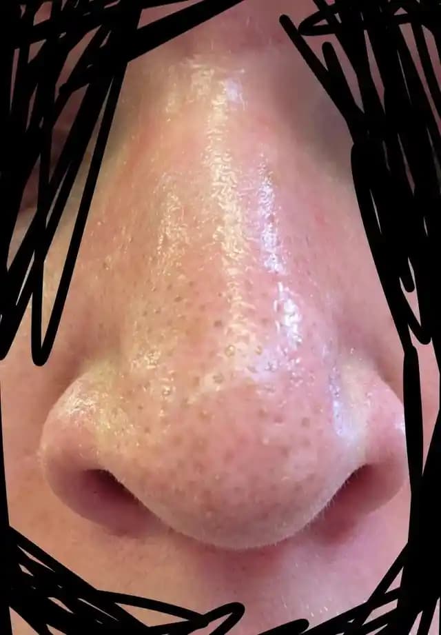 Siyah Noktalar ve Gözenek Temizliği İçin Etkili Yöntemler ve Ürün Önerileri