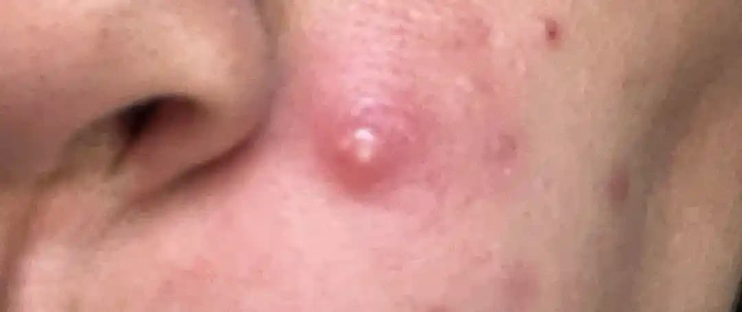 Tek Bir Büyük Sivilceyle Etkili Mücadele Yöntemleri ve Tedavi Seçenekleri