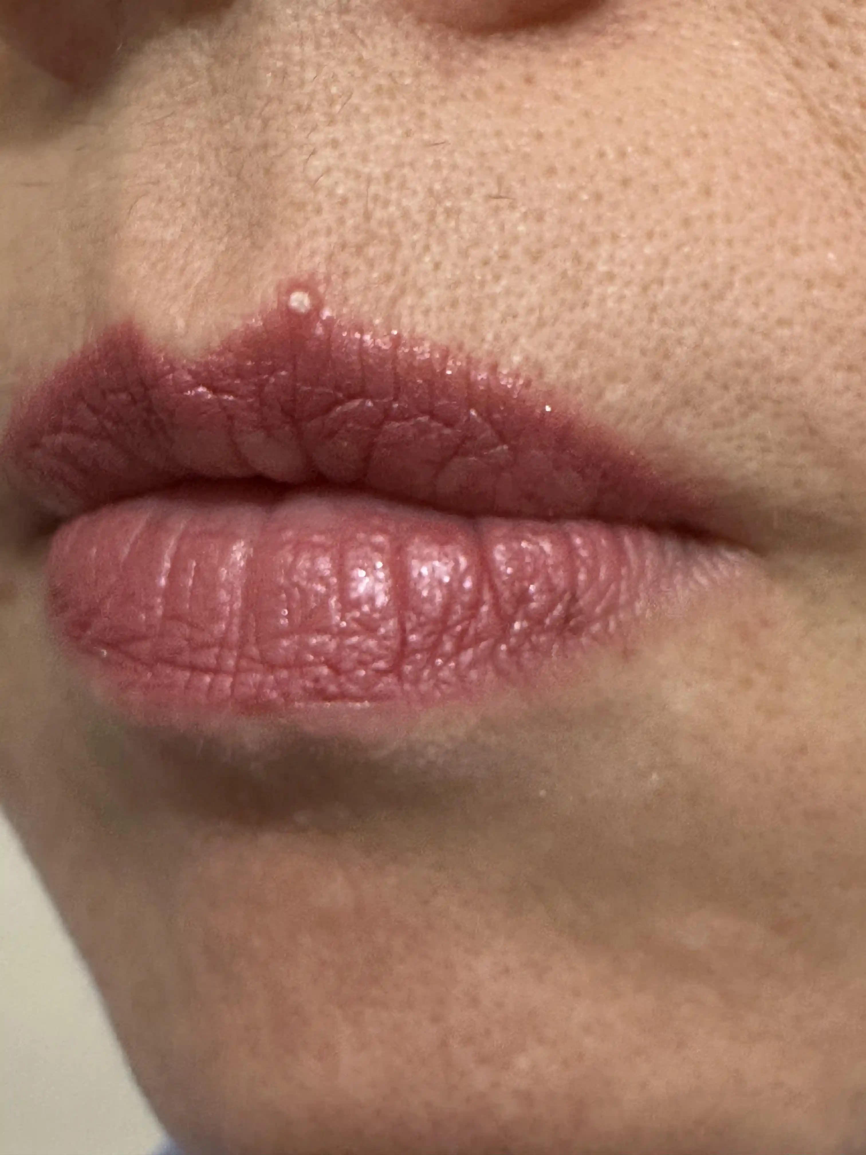 Tekrarlayan Sivilceler: Nedenleri, Riskleri ve Etkili Tedavi Yöntemleri