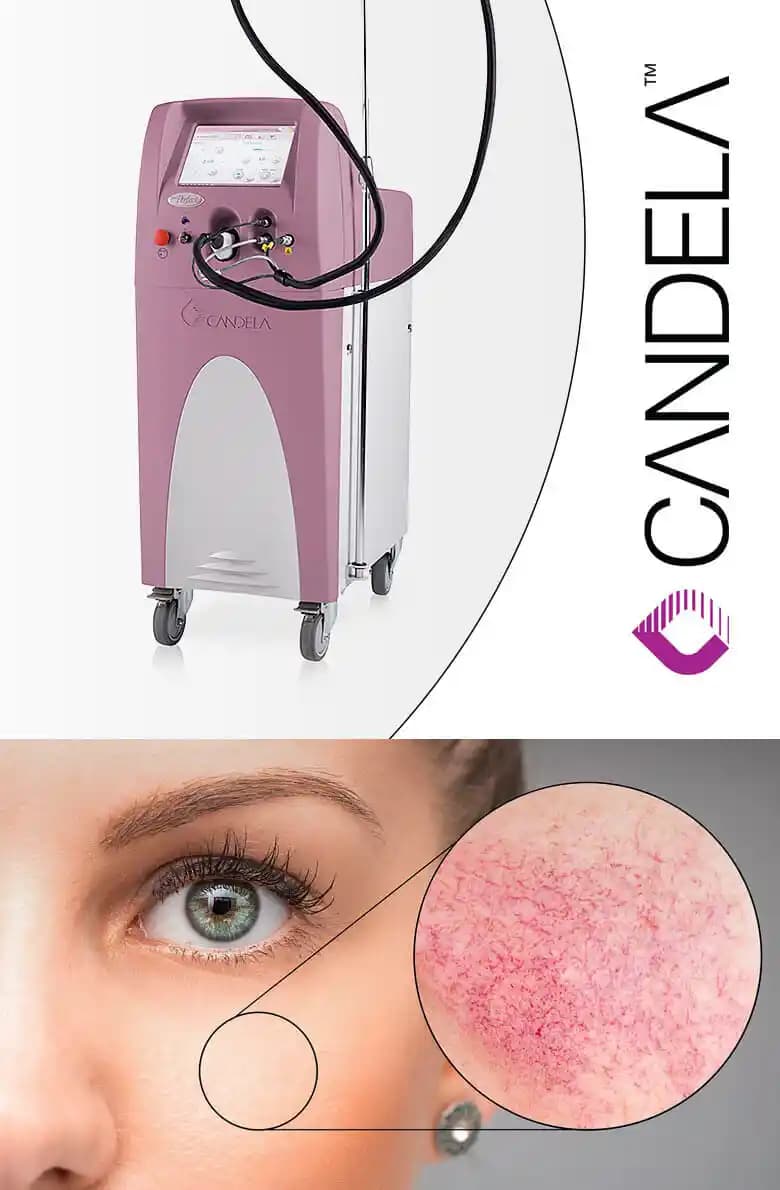 Vbeam Lazer Tedavisi: Kırık Kılcal Damarlar ve Ciltteki Etkileri Üzerine Kapsamlı İnceleme