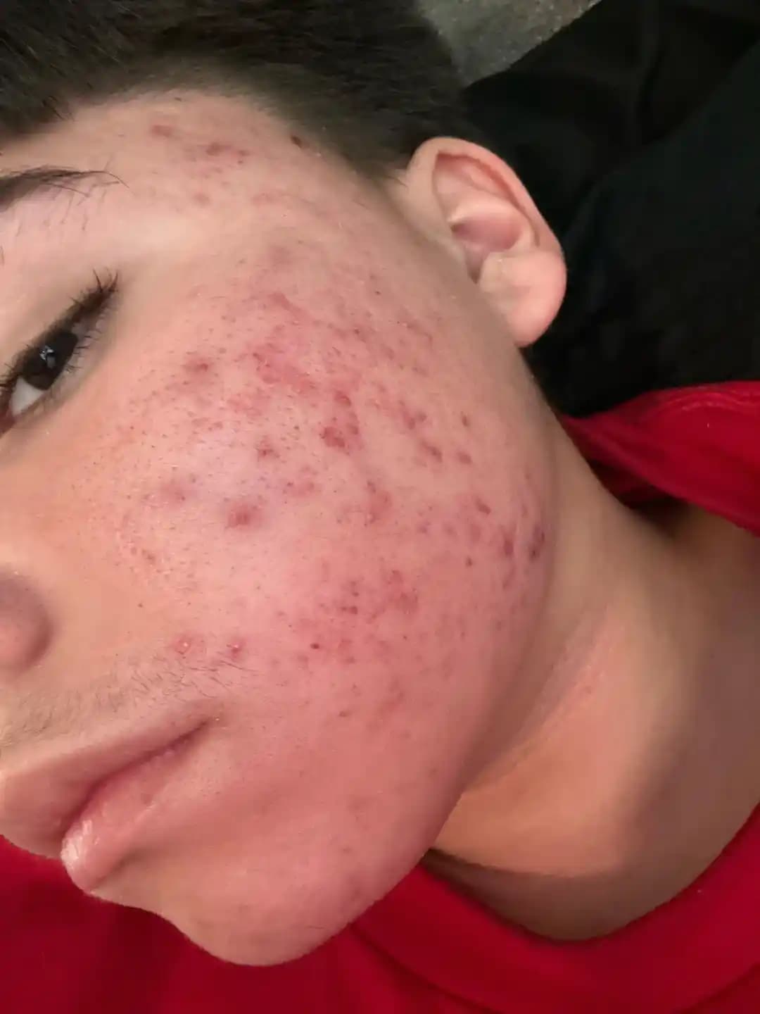 Yağlı Ciltlerde Akne Yönetimi: Etkili Tedavi Yöntemleri ve Bakım Önerileri