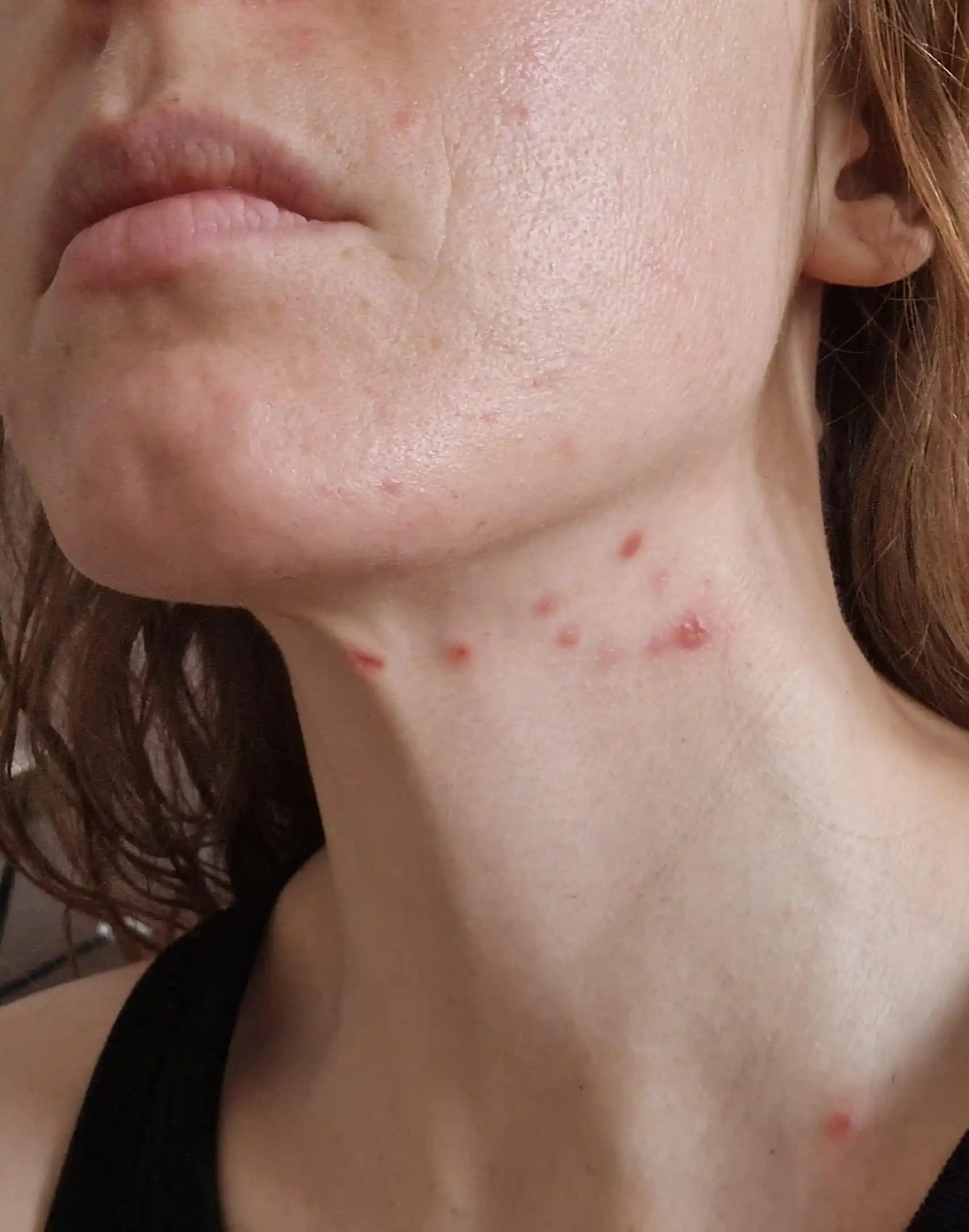 Yetişkinlikte Artan Akne: Nedenleri, Tedavi Yöntemleri ve Yaşam Tarzı Önerileri