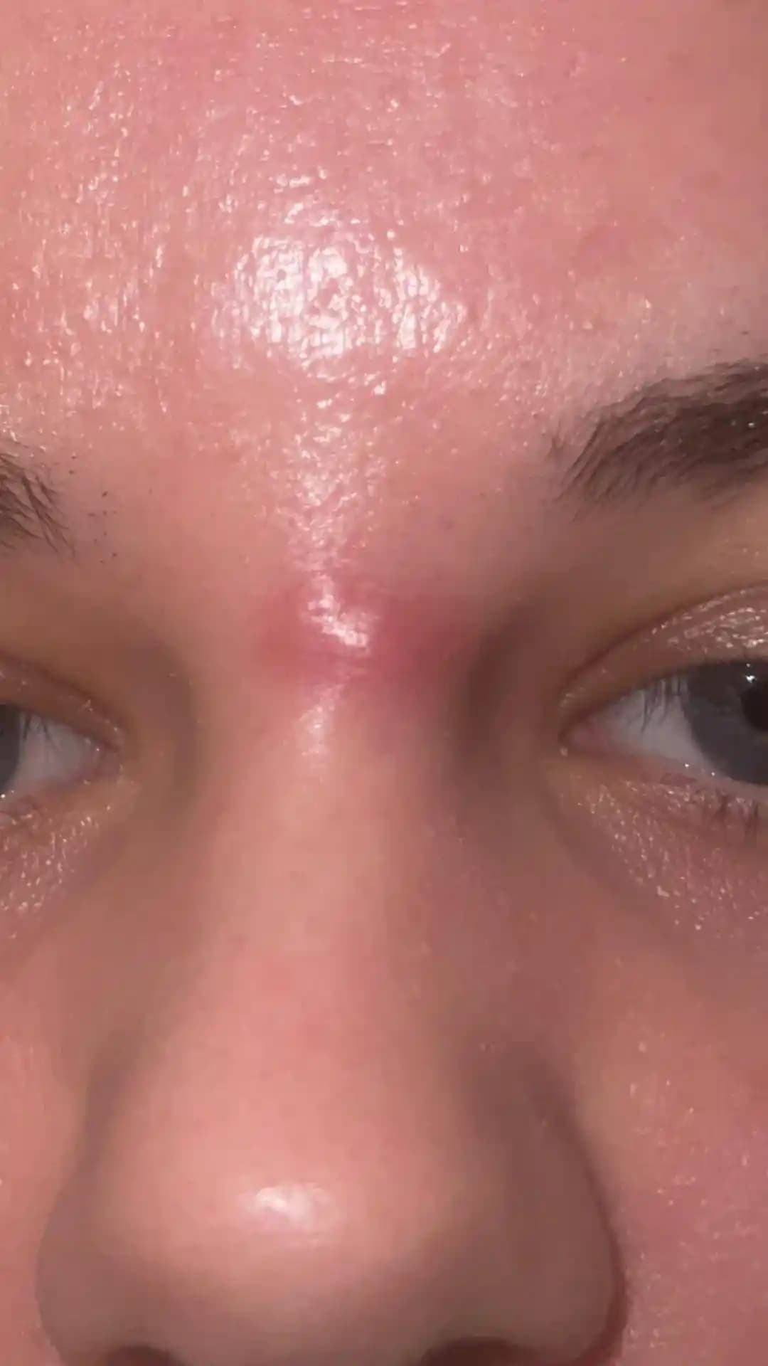 Yüzde Sıvı Dolgulu Baş Çıkmamış Lezyonların Etkili Yönetimi ve Tedavi Yöntemleri