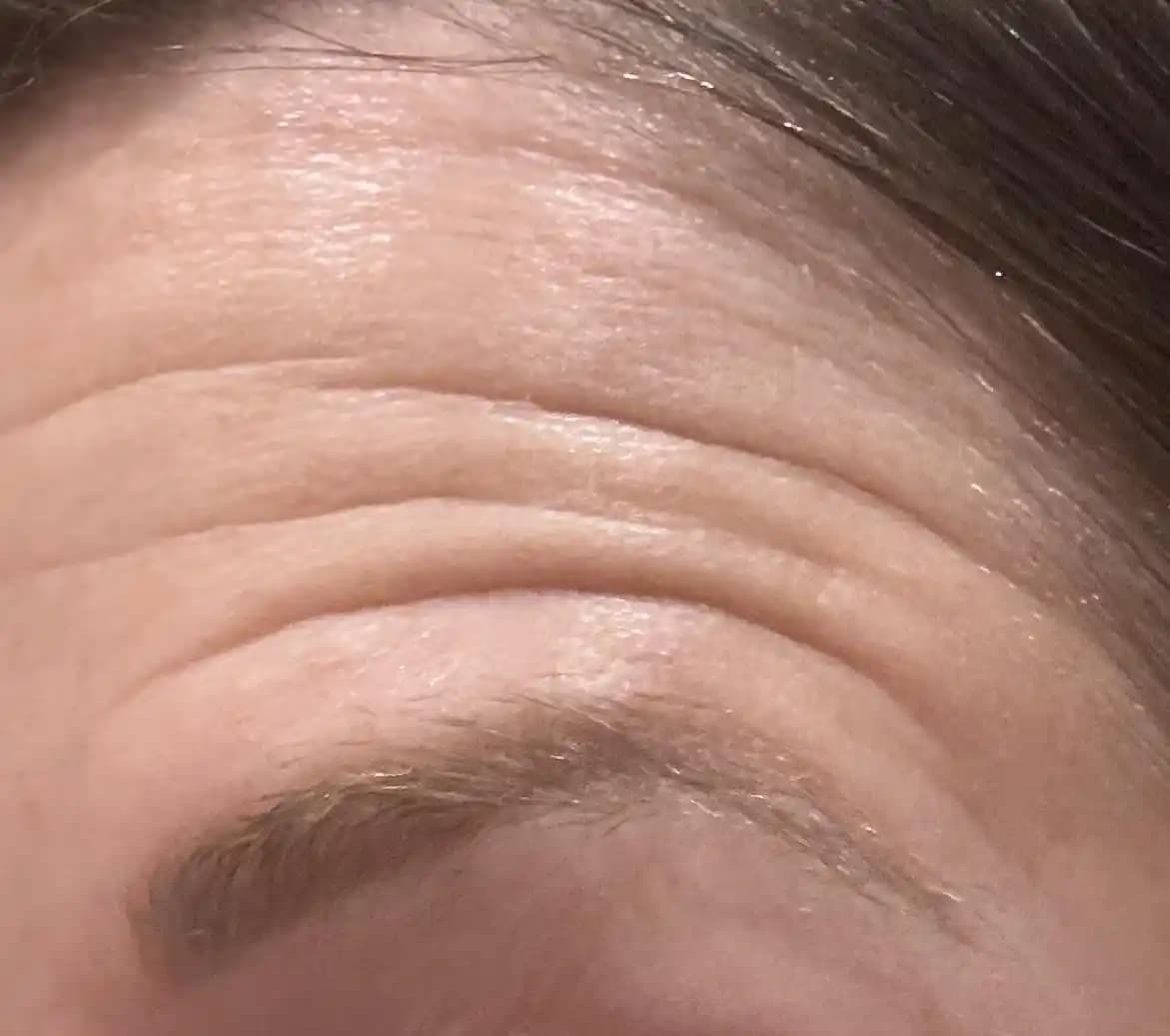 Yüzde Tek Taraflı Derin Kırışıklıklar ve Botoks Tedavisinin Nedenleri ve Çözümleri