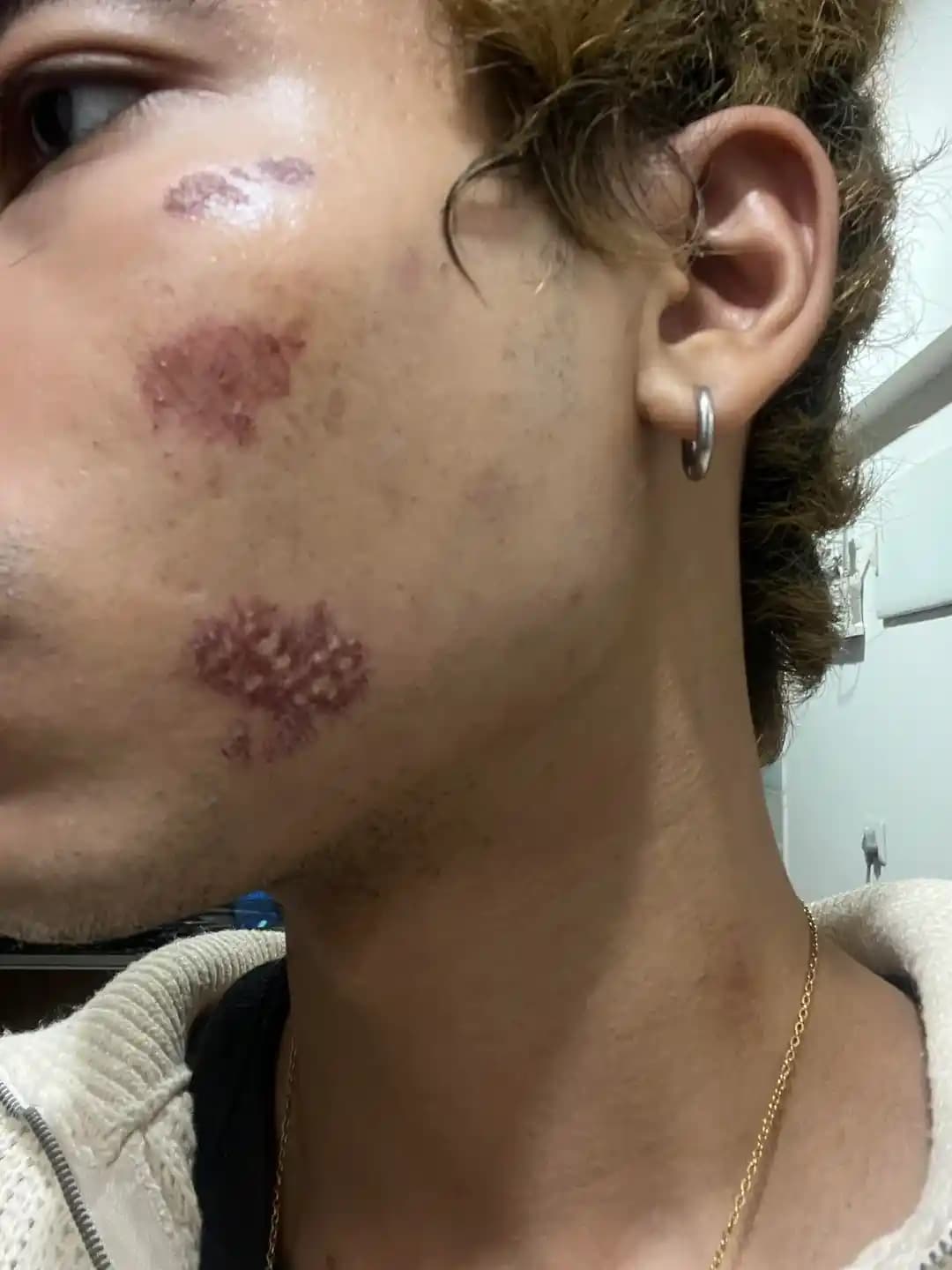 Yüzdeki Sıyrıkların İyileşme Sürecinde İz Oluşumunu Önleme Yöntemleri ve Bakım Önerileri