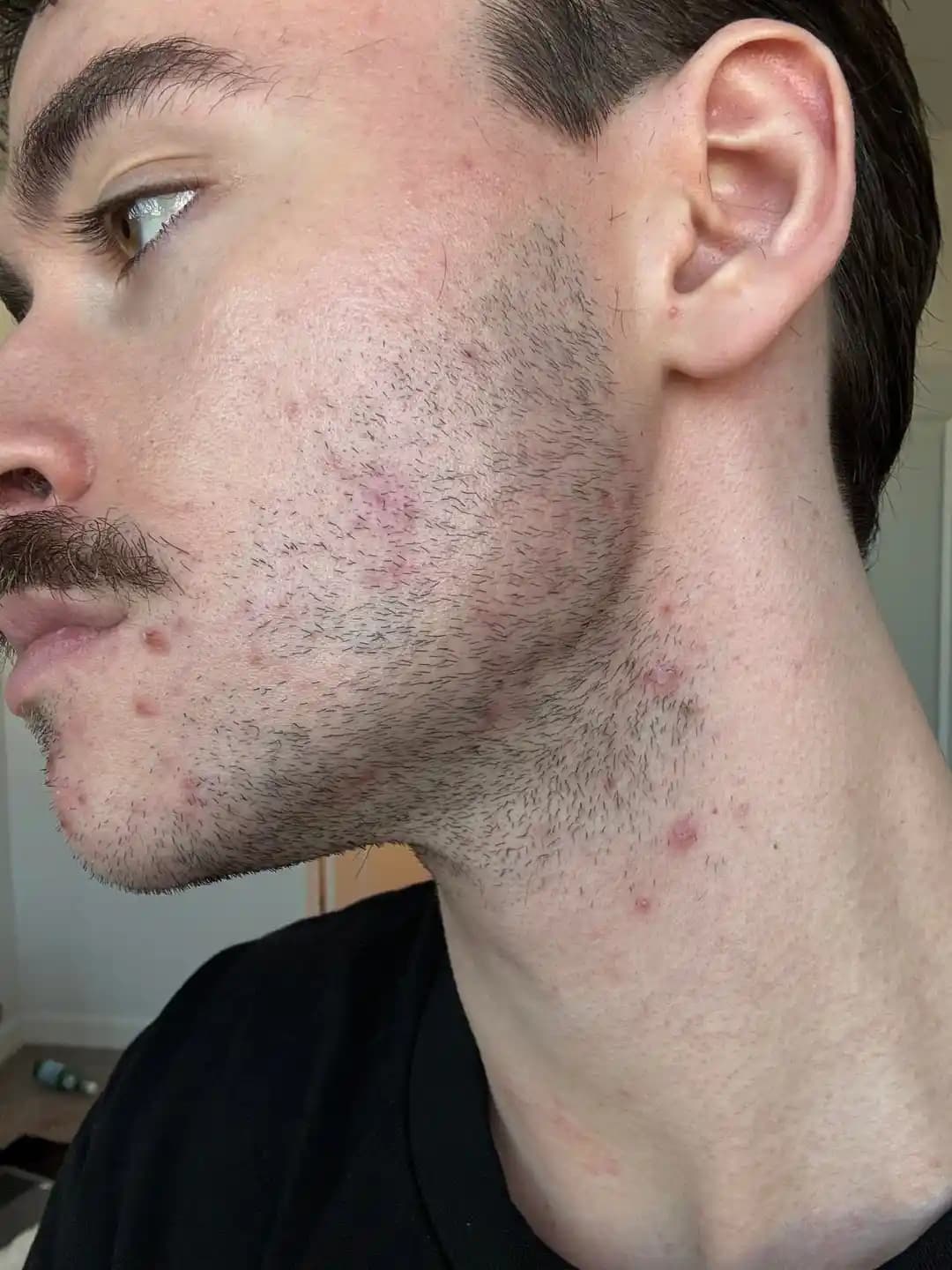 Alt Yüz Bölgesinde Sürekli Sivilce Sorunları ve Etkili Çözüm Yöntemleri