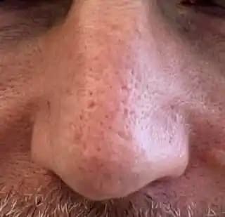 Burun Bölgesindeki Cilt Sorunları: Rosacea, Gözenek Problemleri ve Bakım Yöntemleri