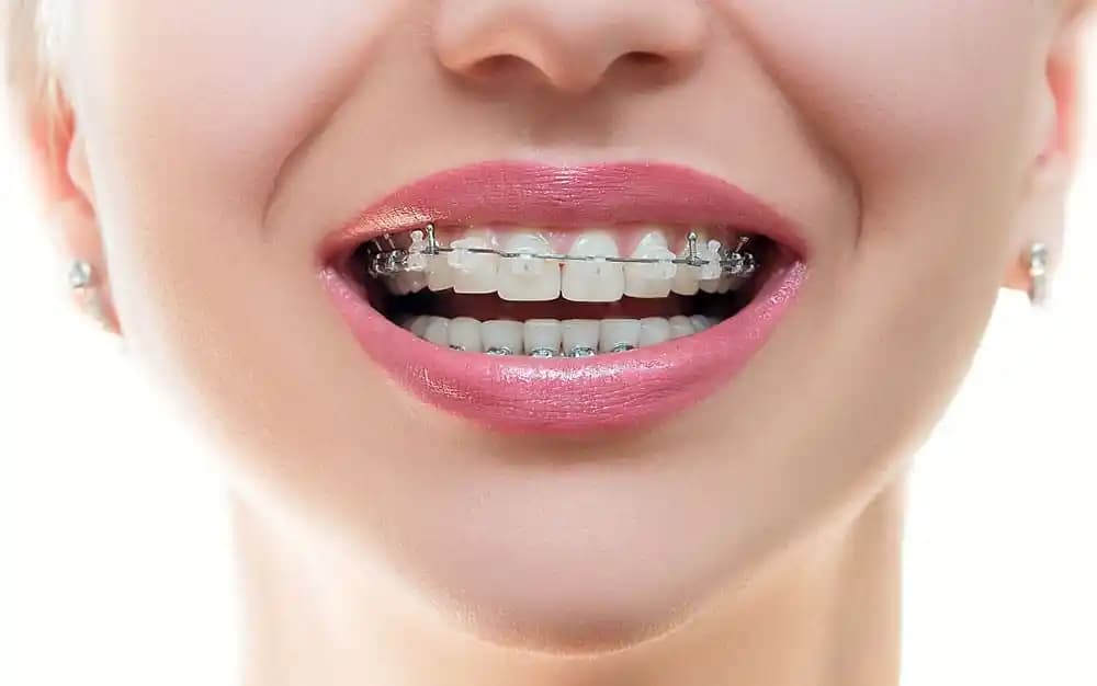 Diş Teli ve Invisalign Karşılaştırması: Ortodontik Tedavi Seçeneklerinin Detaylı İncelemesi