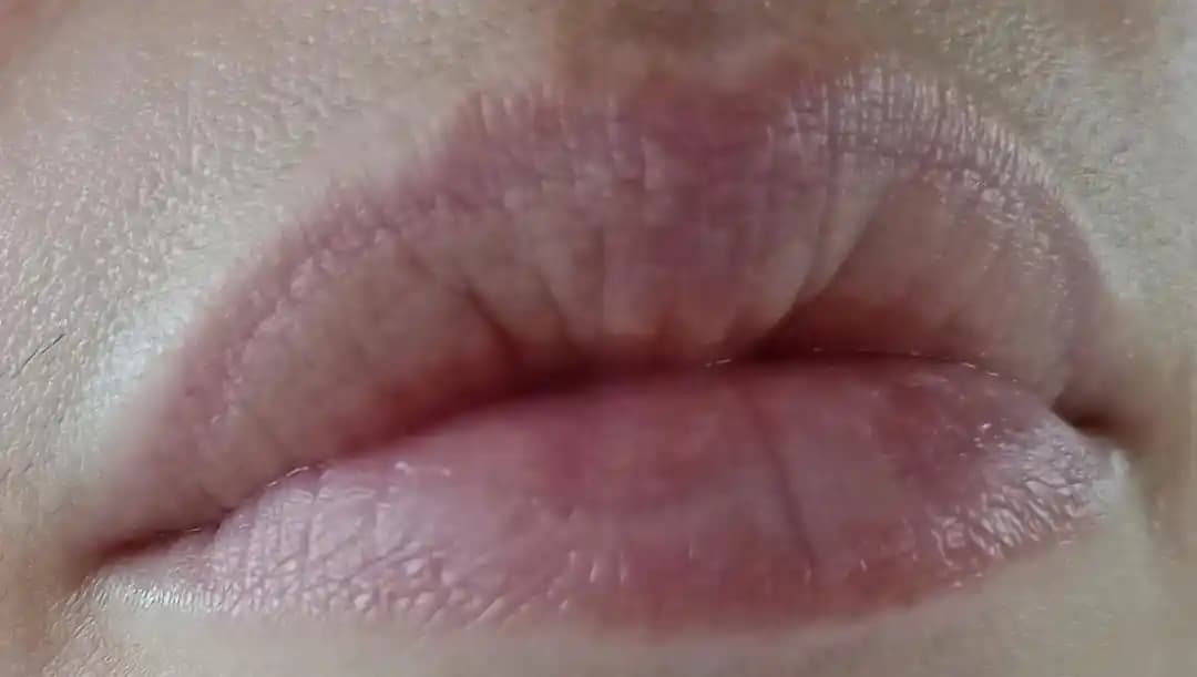 Dudaklarda Renk Değişikliği ve Deri Katmanı Görünümünün Nedenleri ve Tedavi Yöntemleri