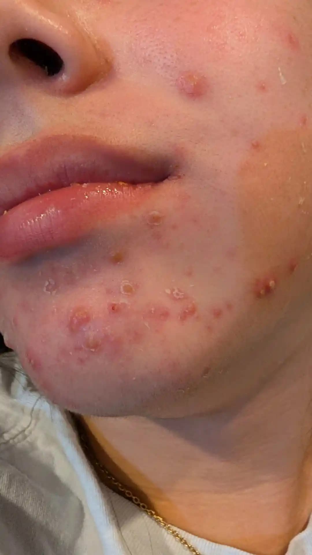 Ergenlikte Şiddetli Akne Tedavisi ve Cilt Bakımında Doğru Yaklaşımlar