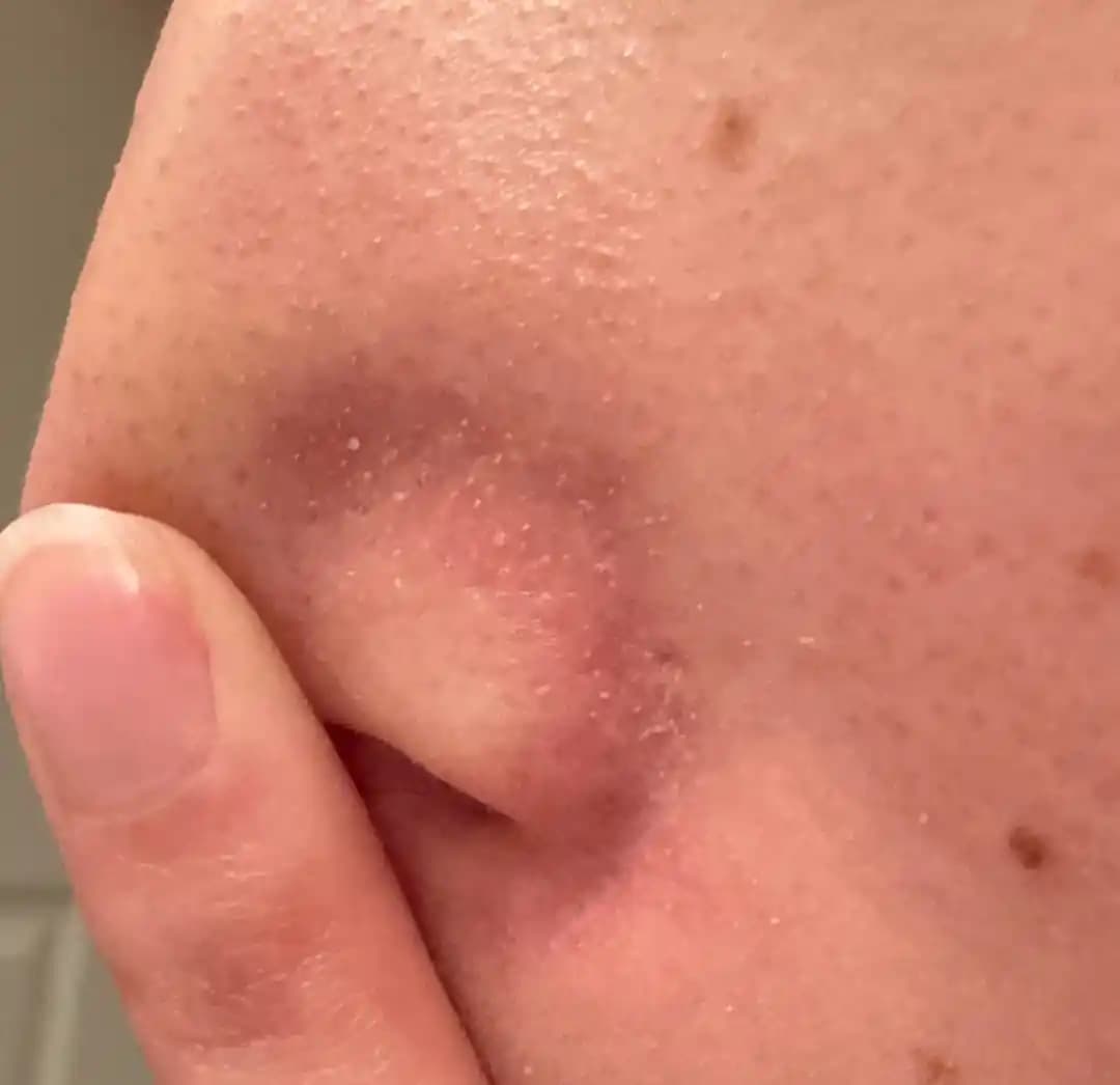 Hasar Görmüş Sebum Filamentleri ve Cilt Bakımında Doğru Yaklaşımlar: Etkili Yöntemler ve Öneriler