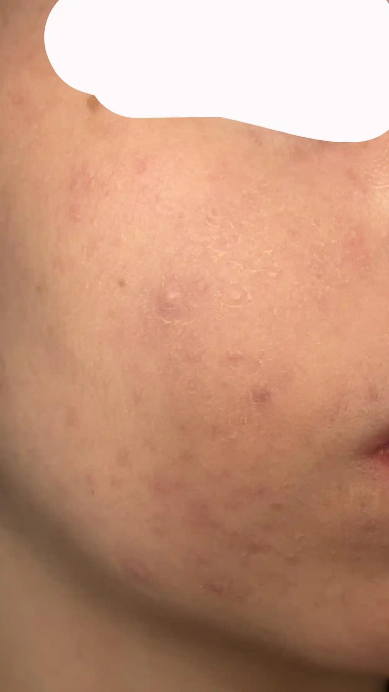 Kapatıcıların Ciltte Soyulma ve Topaklanma Sorunları: Nedenler ve Etkili Çözümler