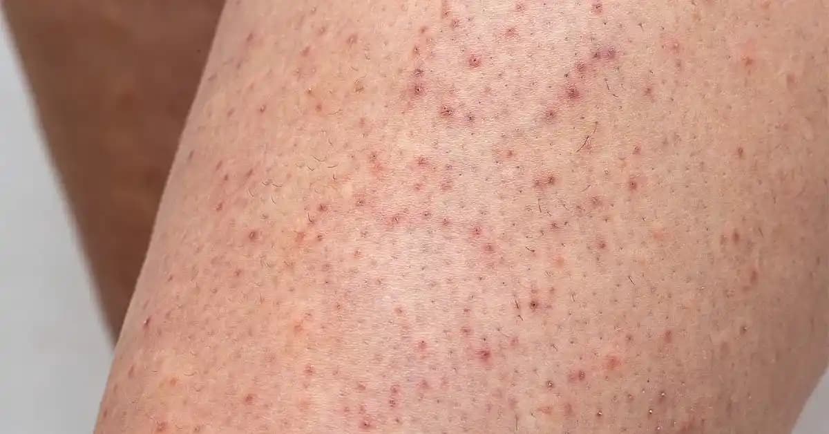 Keratosis Pilaris (Tavuk Derisi) Tedavi Yöntemleri ve Psikolojik Etkileri Üzerine Kapsamlı İnceleme