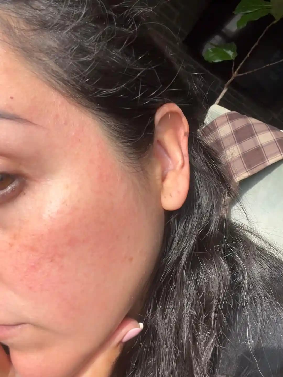 Rosacea ve Hassas Ciltlerde Doku Problemleri: Nedenleri, Yönetimi ve Cilt Bariyeri Onarımı