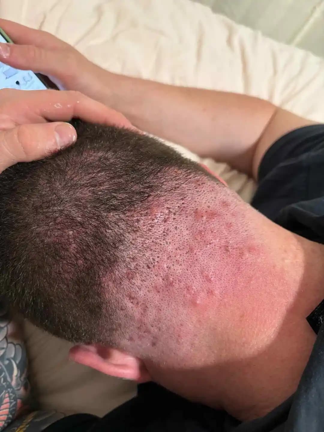 Saç Derisi Aknesi ve Folikülit: Nedenleri, Belirtileri ve Etkili Tedavi Yöntemleri