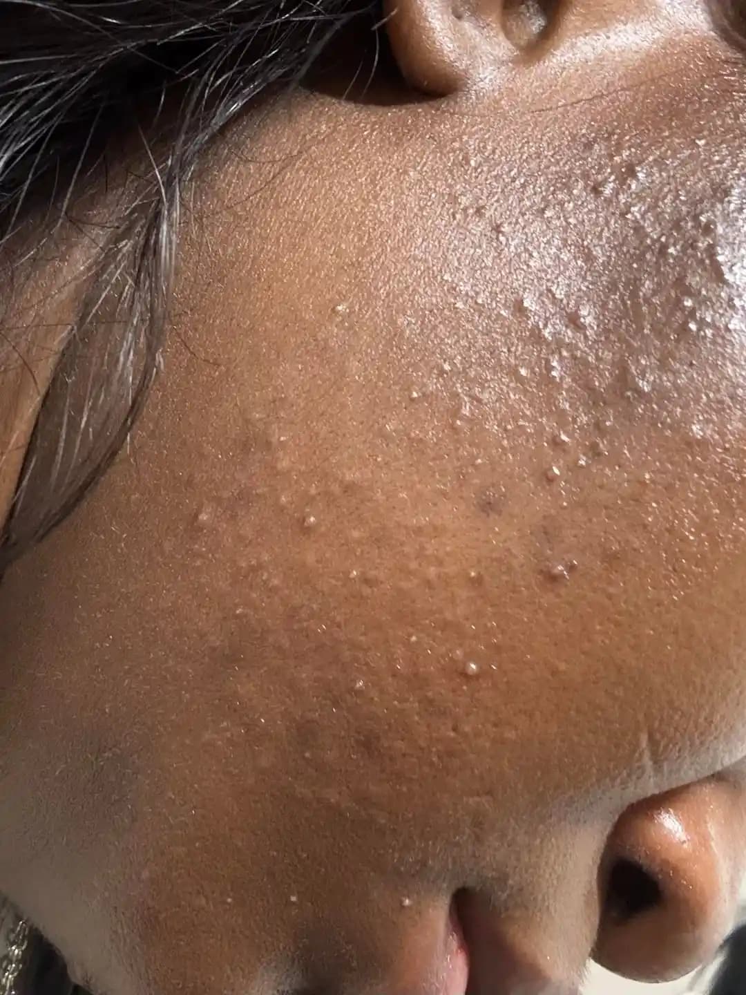 Yanaklarda Kum Torbası Hissi ve Akne: Cilt Bariyeri, Mikrobiyom ve Tedavi Yaklaşımları