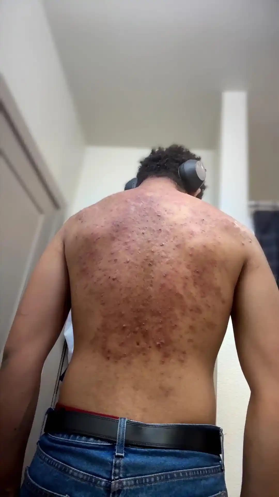 Akne Tedavisinde Accutane Kullanımı: Etkileri, Yan Etkileri ve Deneyimler