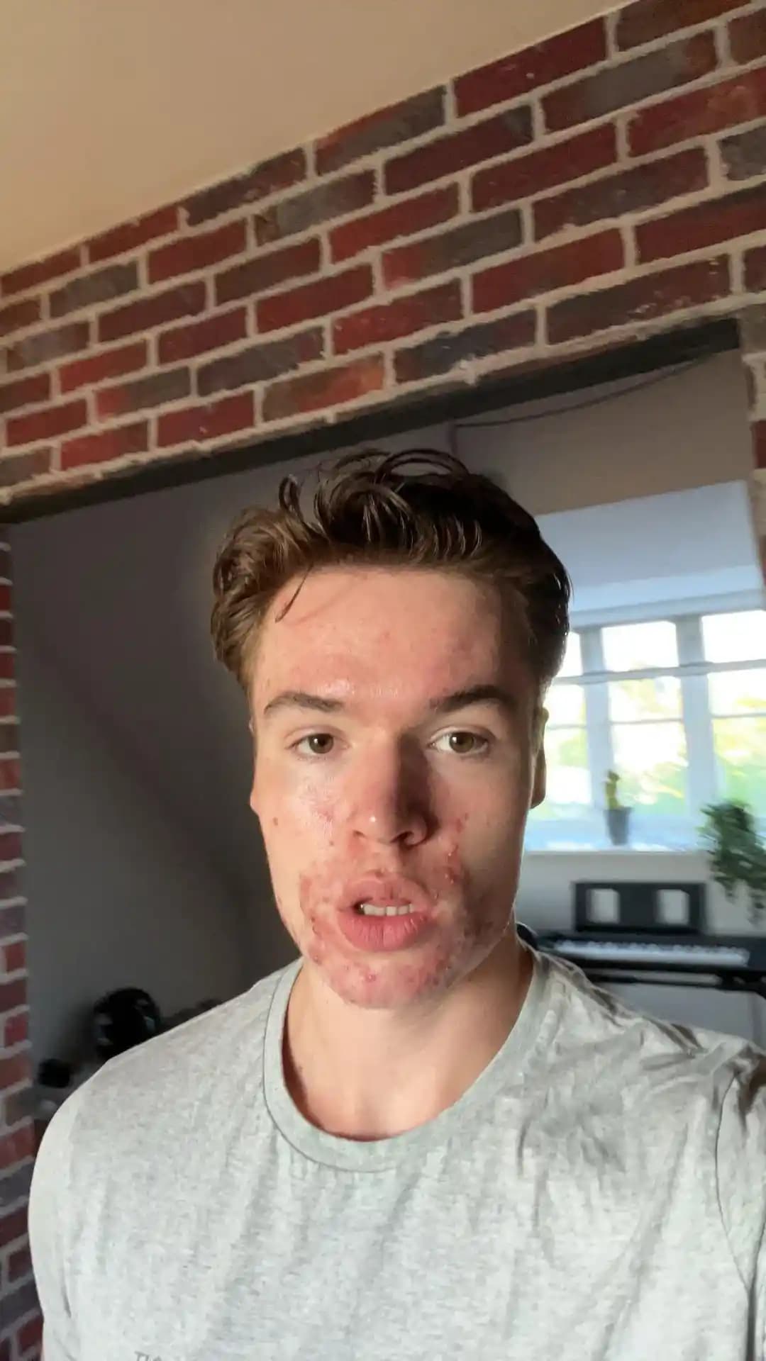 Akne ve Psikososyal Etkileri: Cilt Sorunlarının Bireylerin Yaşamına Yansımaları