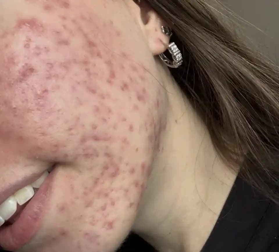 Azelaik Asit ile Akne Tedavisinde Etkili Kullanım ve Cilt Bakımı Yaklaşımları