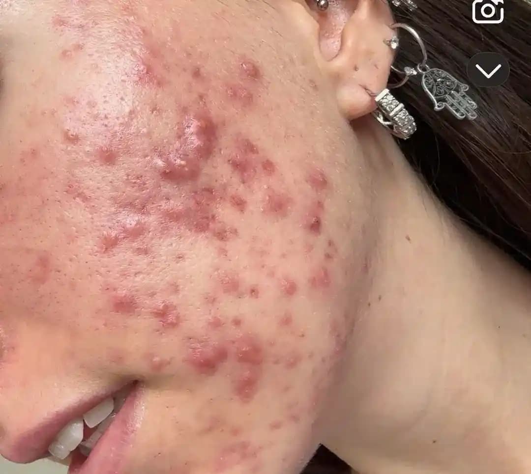 Azelaik Asit ve Benzoyl Peroksit ile Akne İzlerinin 6 Ayda İyileşme Süreci ve Ürün Kullanımı