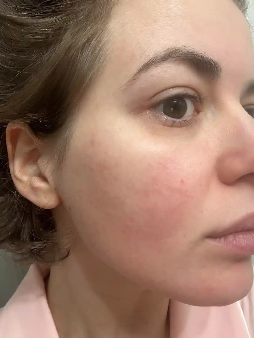 BBL ve Moxi Lazer Tedavisi ile Rosacea ve Hiperpigmentasyon Sorunlarının Etkili Yönetimi