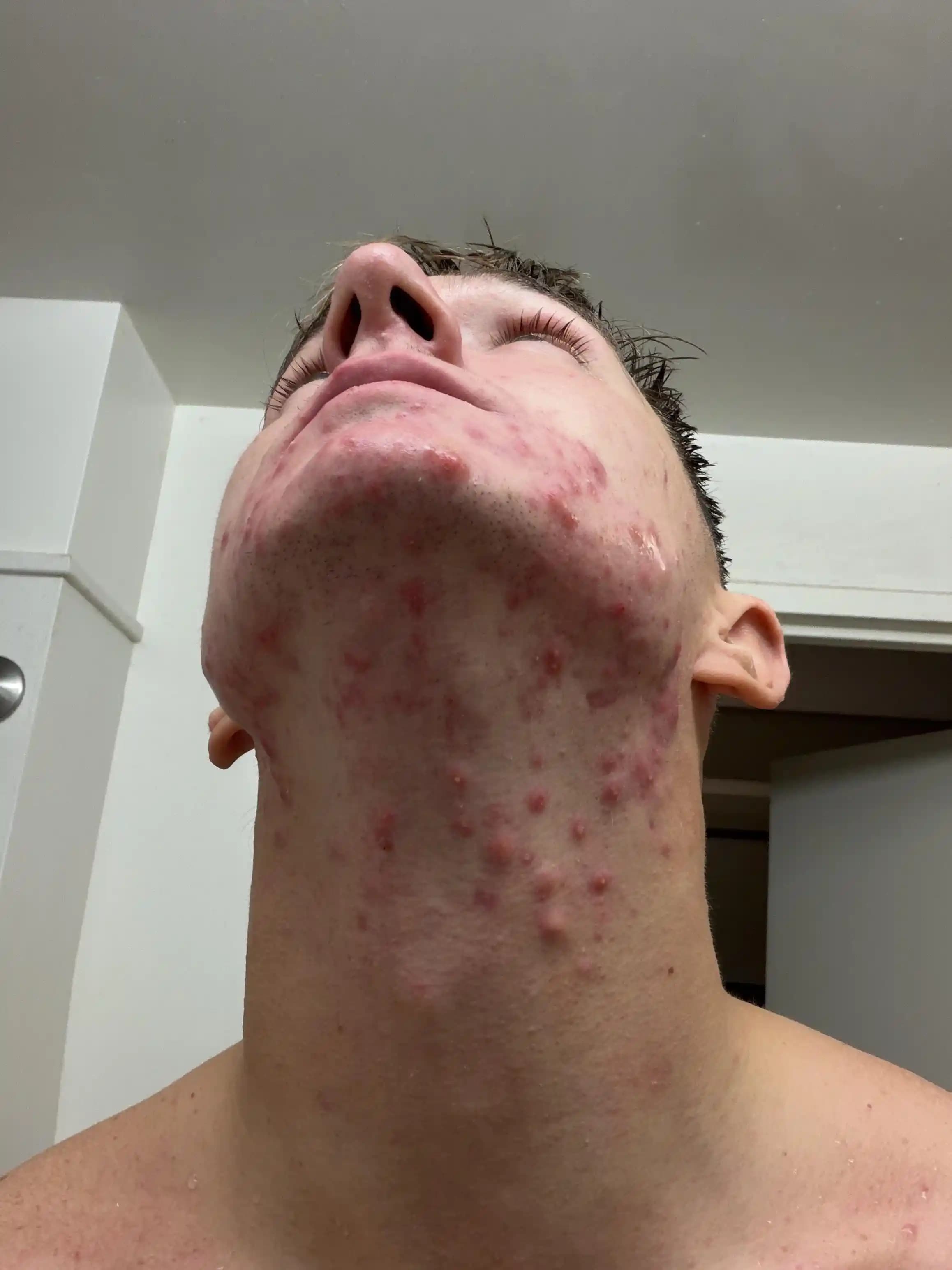 Boyun Bölgesinde Akne Nedenleri ve Etkili Tedavi Yöntemleri Hakkında Bilgi