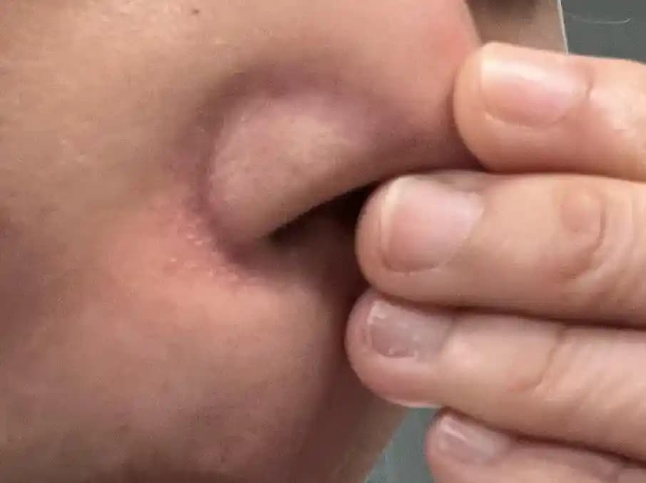 Burun Kenarlarında Kızarıklık ve Kırmızı Damarların Nedenleri ile Etkili Tedavi Yöntemleri