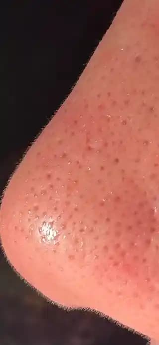 Büyük Gözenekler ve Yağlı Cilt İçin Etkili Bakım Yöntemleri ve Ürünler