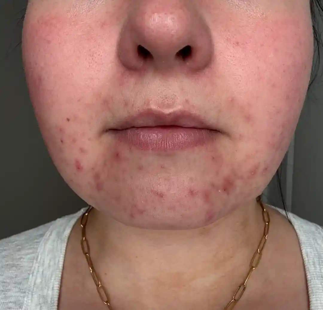 Çene ve Alt Yüz Bölgesindeki Hormonal Aknenin Nedenleri ve Etkili Tedavi Yöntemleri